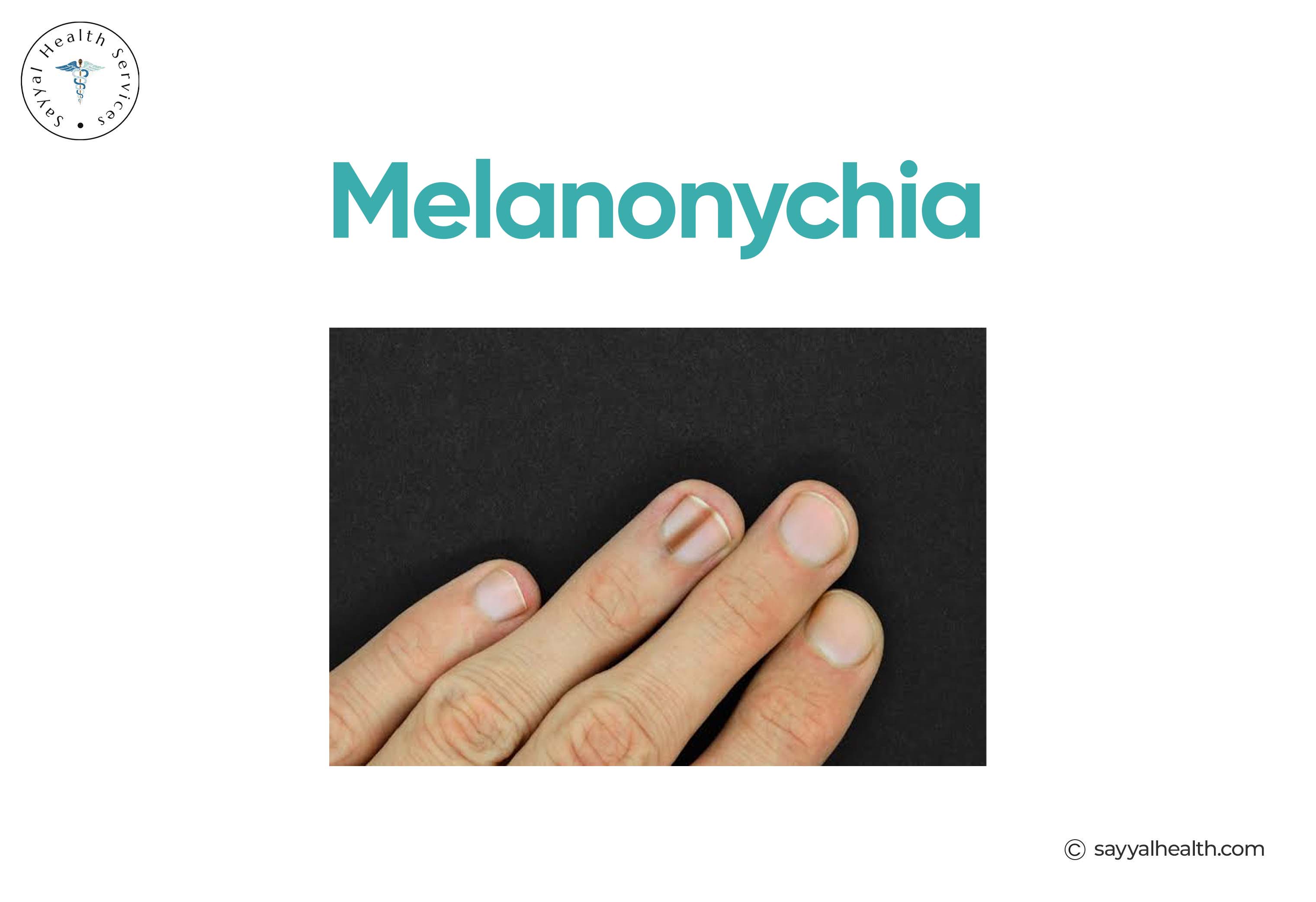 Melanonychia Nail Melanoma
